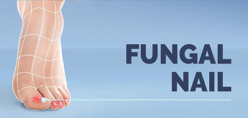 UNDERSTAND AND MANAGE: FUNGAL NAIL