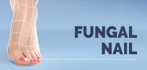 UNDERSTAND AND MANAGE: FUNGAL NAIL