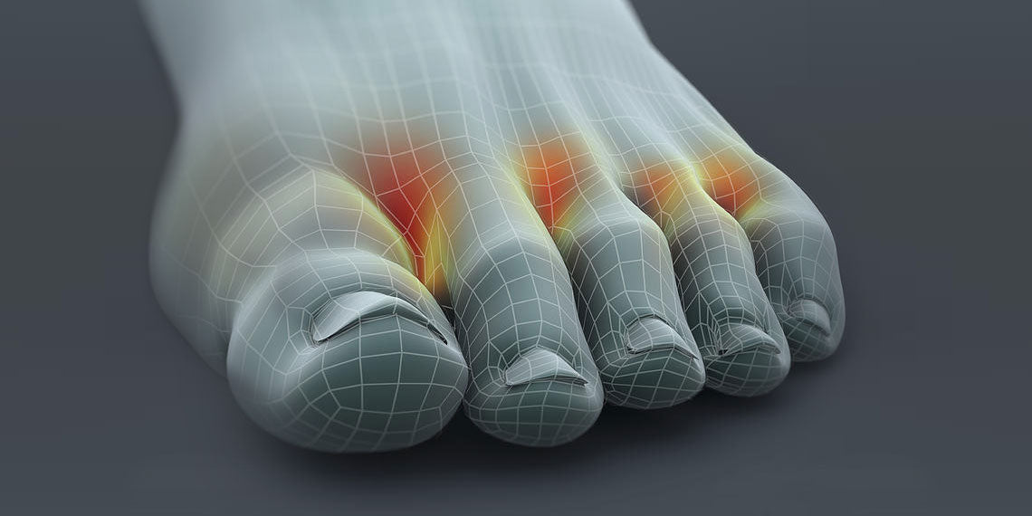 Oh, the Relief! How to get rid of those itchy feet.